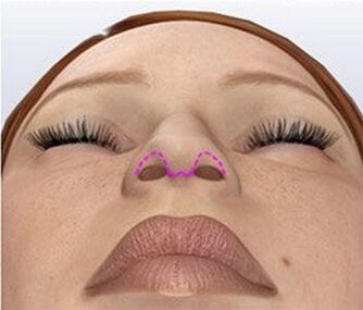 Correction du nez