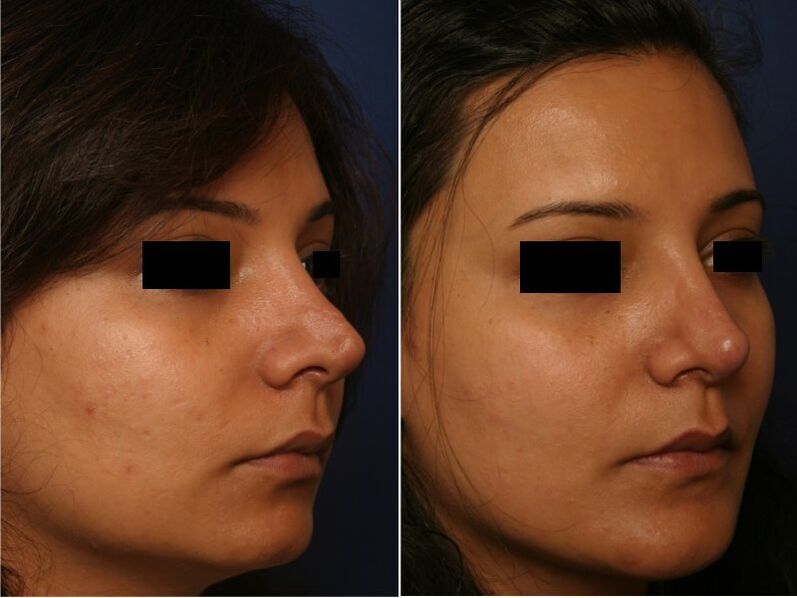 Résultat de la chirurgie plastique