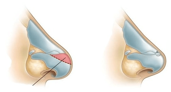 Correction de la forme du nez