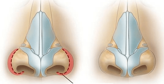 Réduction des narines