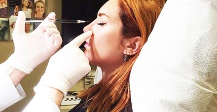 Rhinoplastie avec fillers