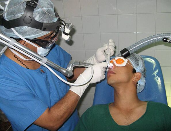 Correction du septum avec un scalpel laser