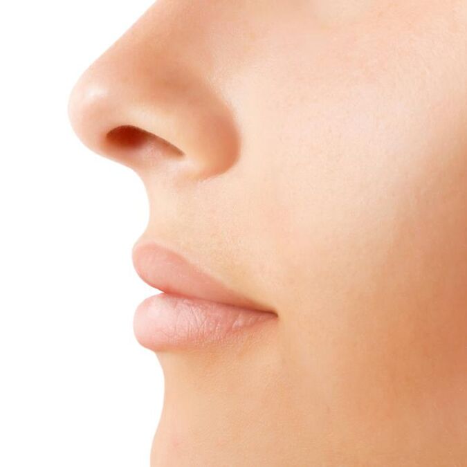 Résultat d'une rhinoplastie ouverte