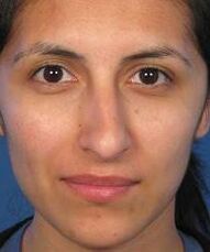 Une forme irrégulière du nez est une raison pour la chirurgie plastique