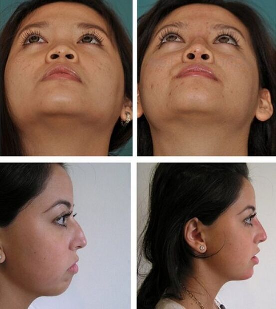 Photos avant et après rhinoplastie sans chirurgie