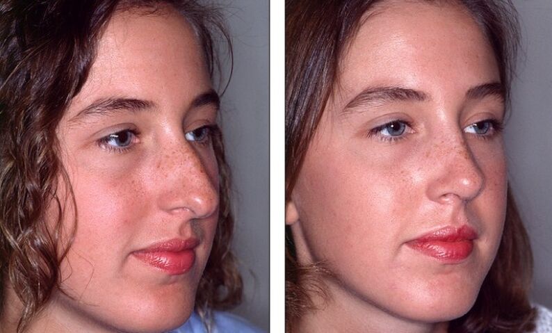 Nez avant et après une rhinoplastie ratée