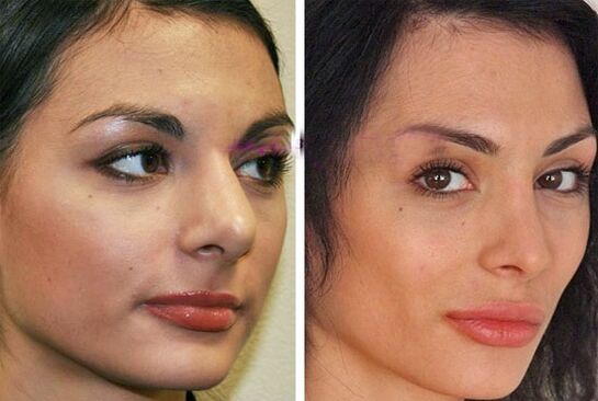 Nez avant et après la chirurgie plastique