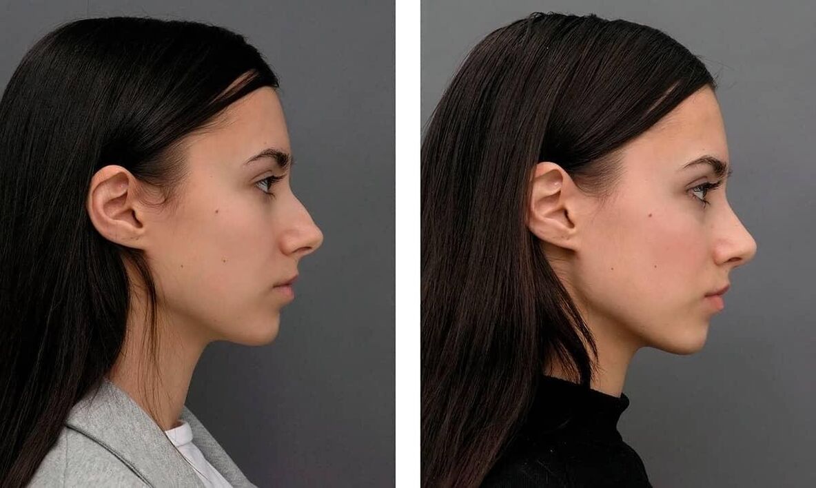 Photos avant et après rhinoplastie
