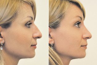 Non-chirurgicale rhinoplastie avant et après les photos